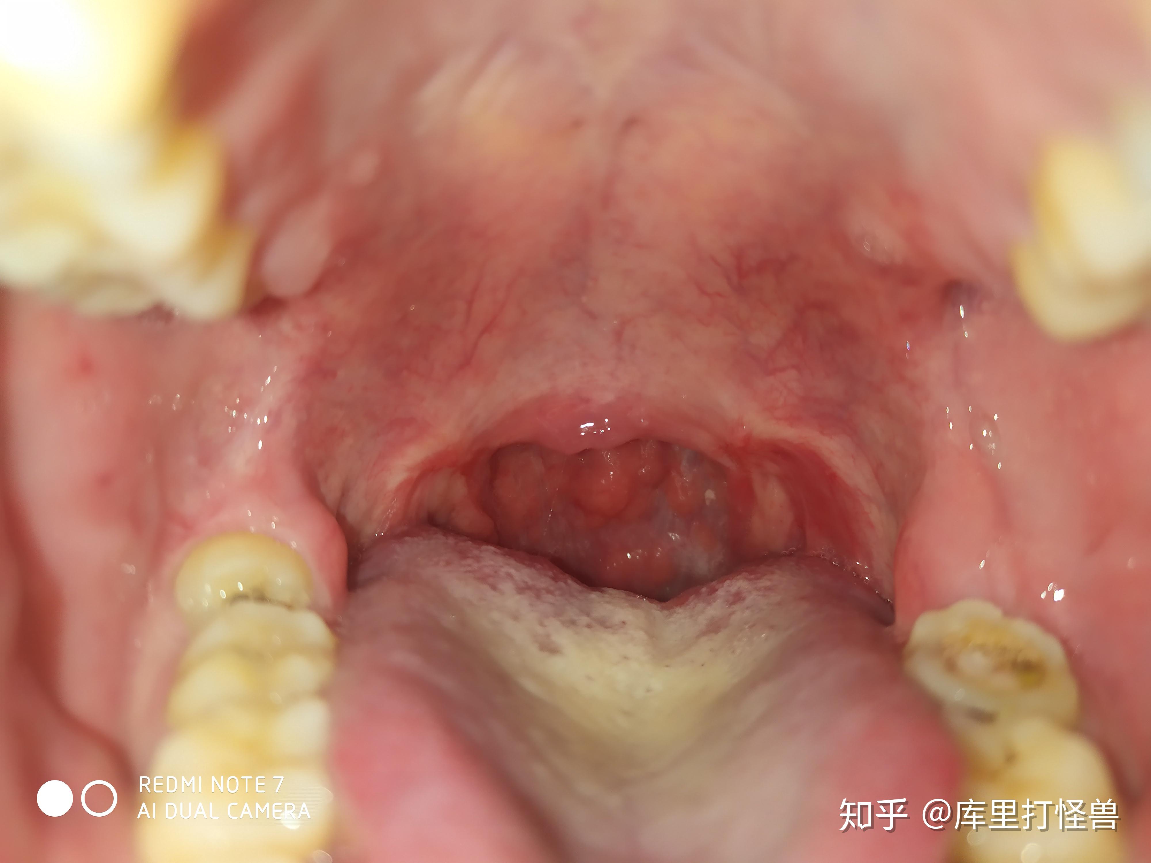 切扁桃体之后是什么感觉