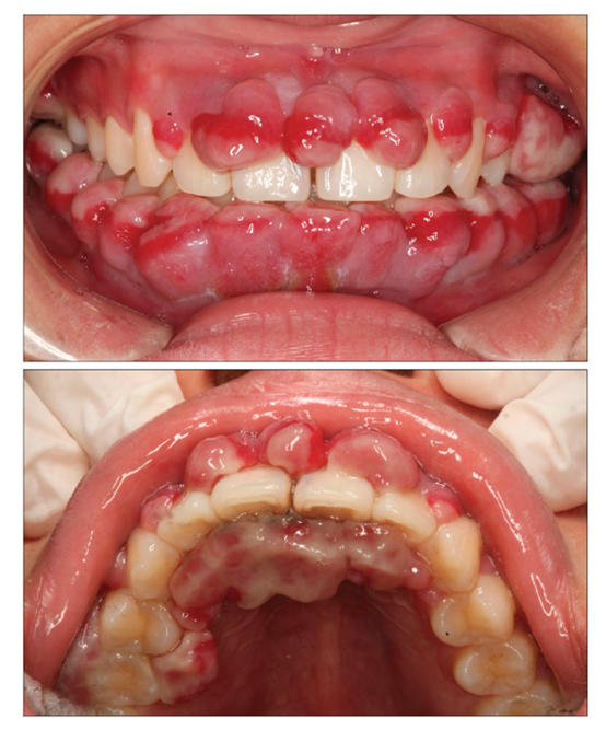牙疼过后牙龈上出现小肉瘤怎么办? 