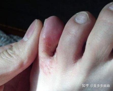 水泡型脚气的病症