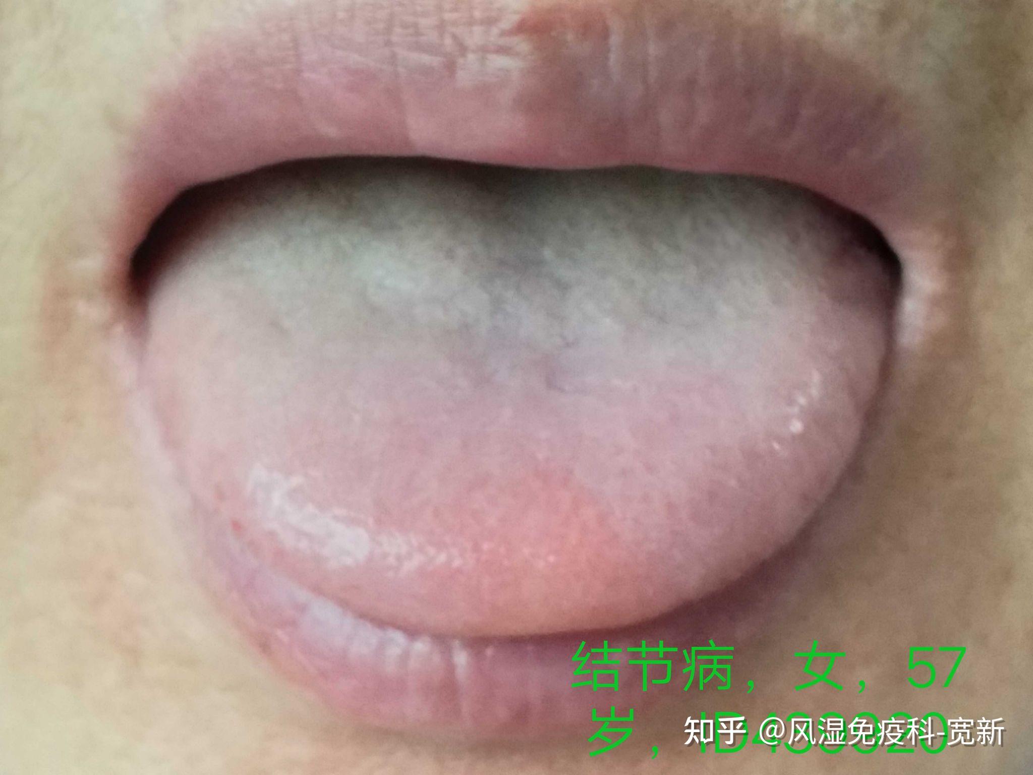 舌头长溃疡了怎么快速好? - 知乎