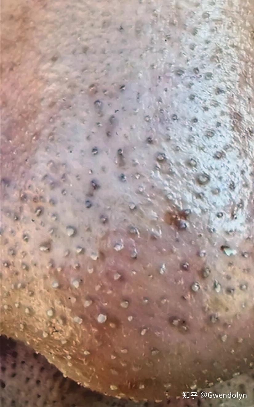 如何区别黑头和小棘毛雍症? - 知乎