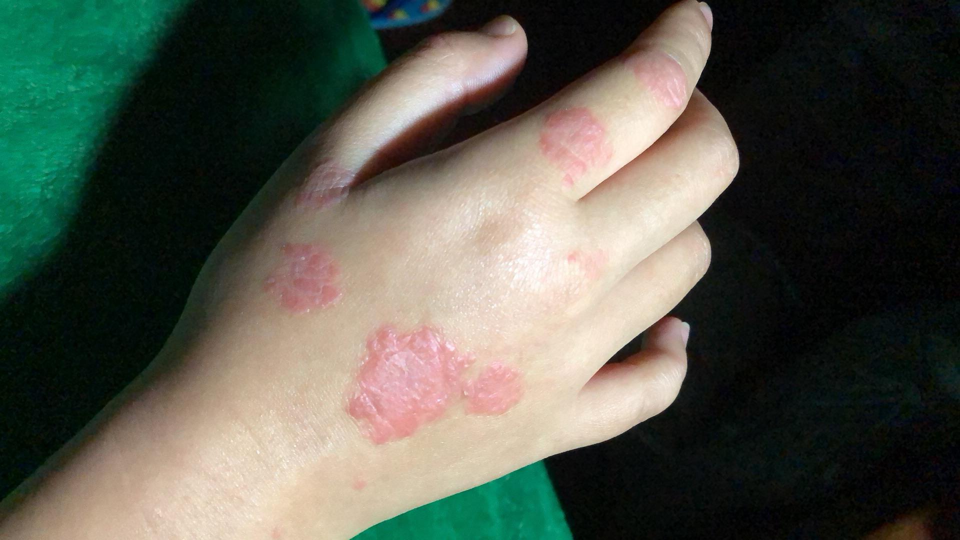 女生得了牛皮癣是一种什么体验能治好吗