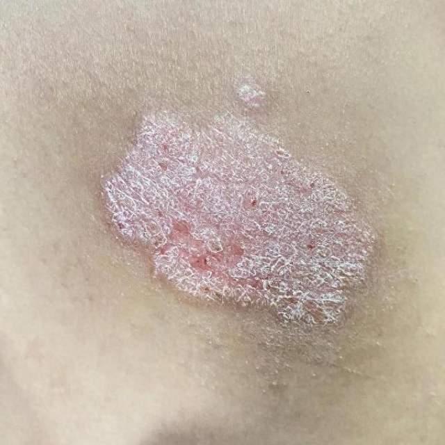 多年牛皮癣,原来是体内热毒作祟!中医一方子,清除湿热, - 知乎