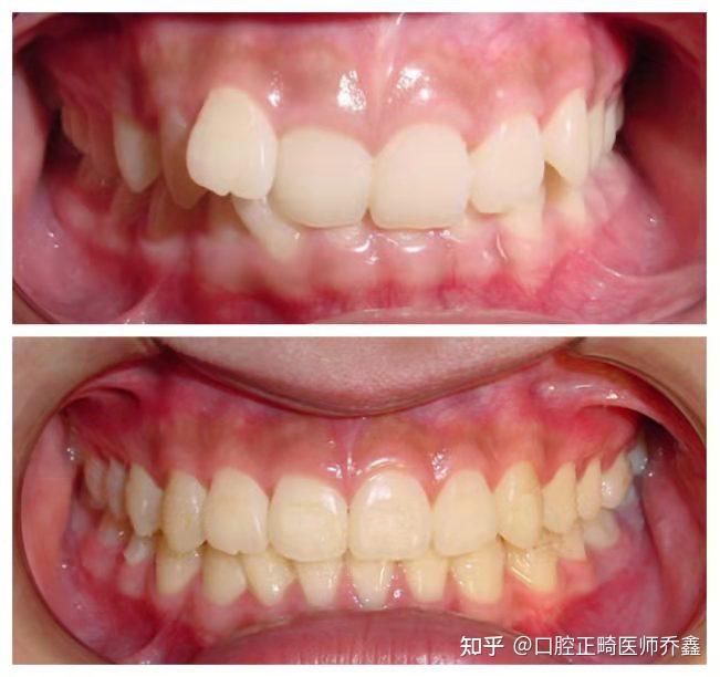 牙齿内倾型深覆合用不用矫正