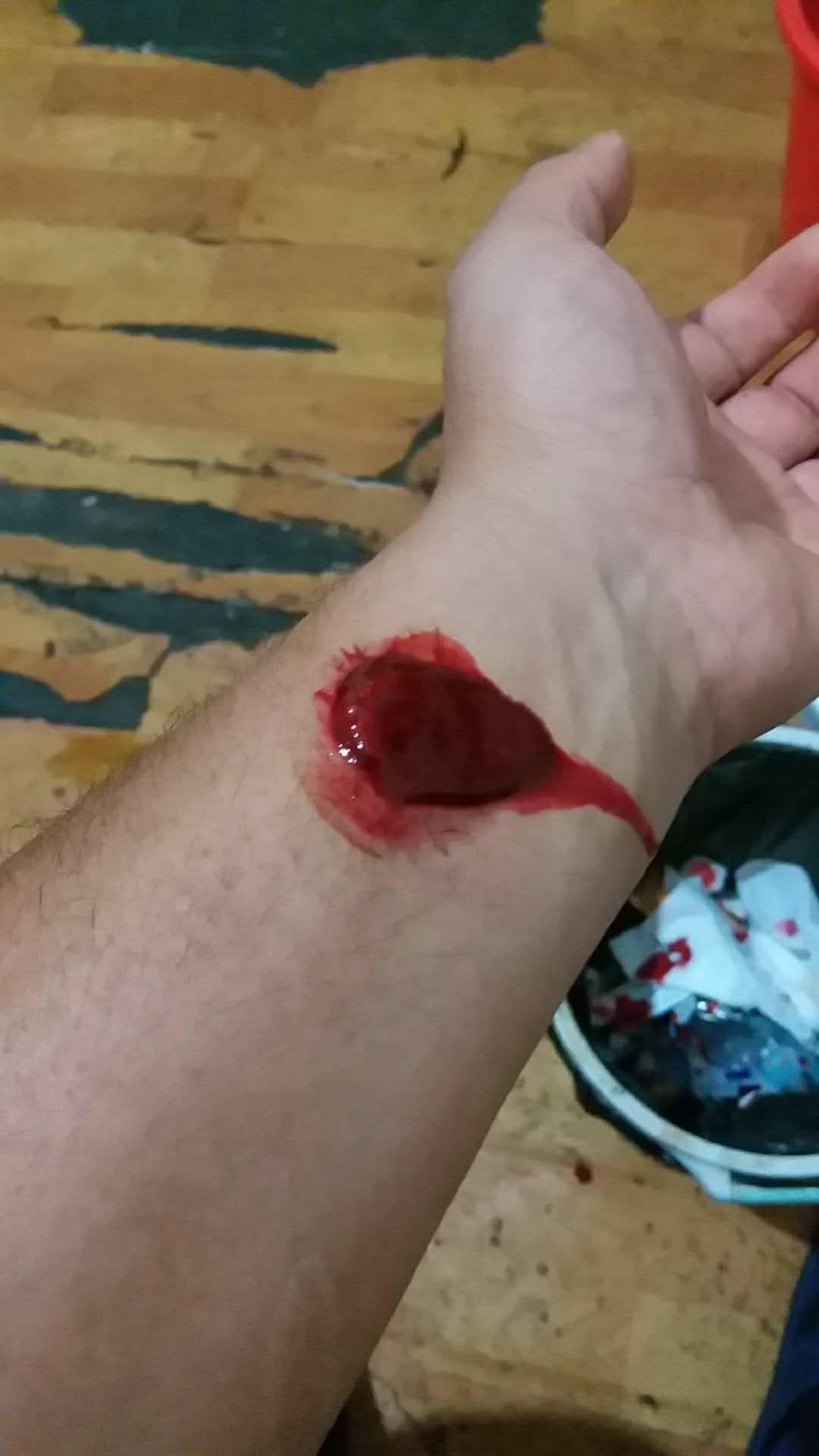 用梅花针拔气罐法从血液中出来的果冻状的东西是什么