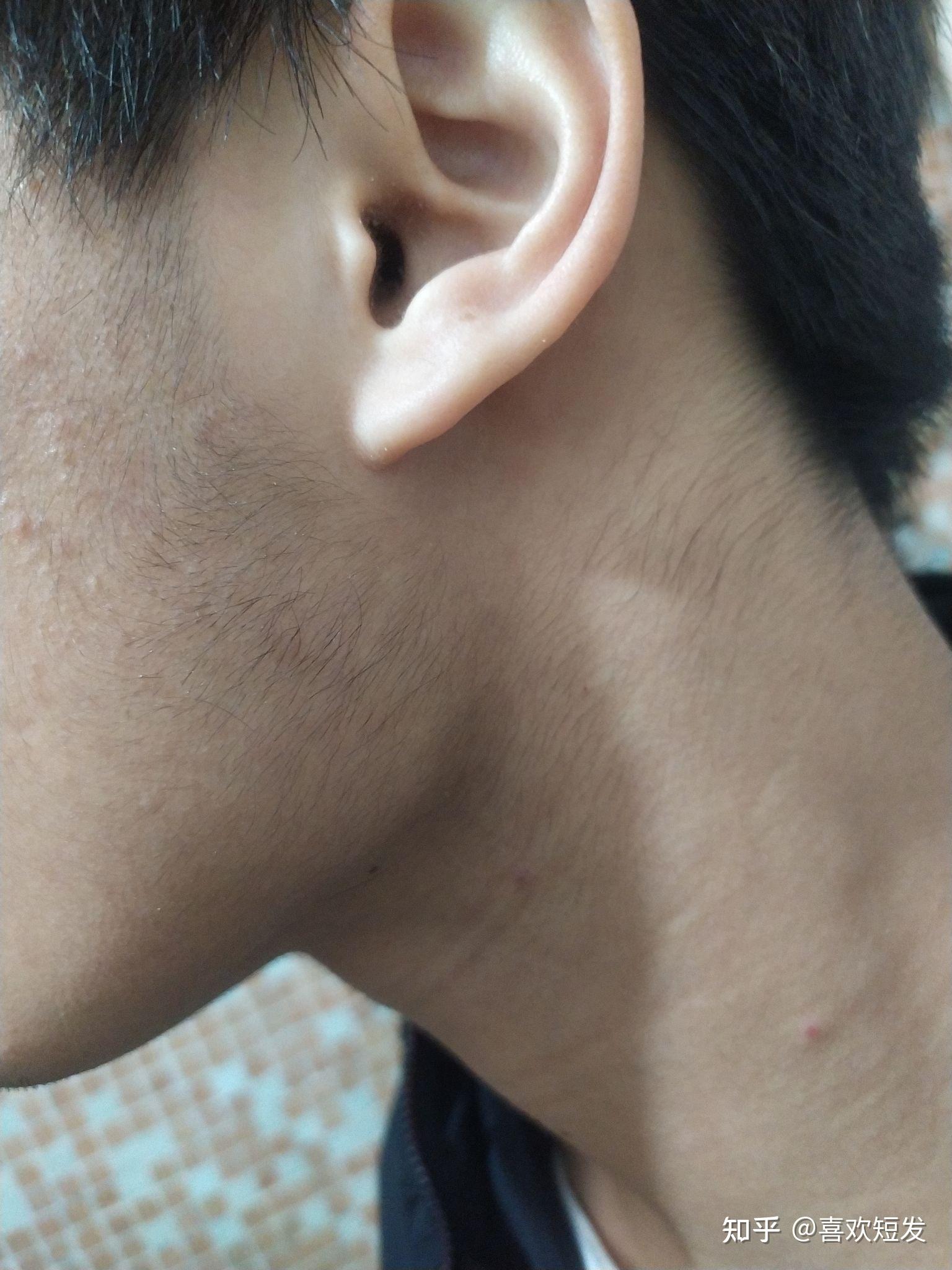 男17岁发现脸上的汗毛越来越长两腮的毛得越来越黑长了怎么办