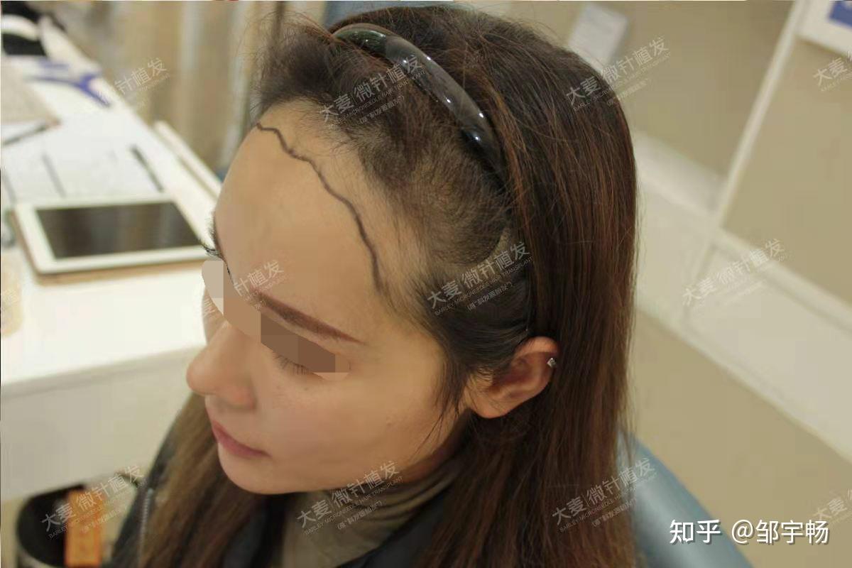 女子记录一年掉发39357根 知乎