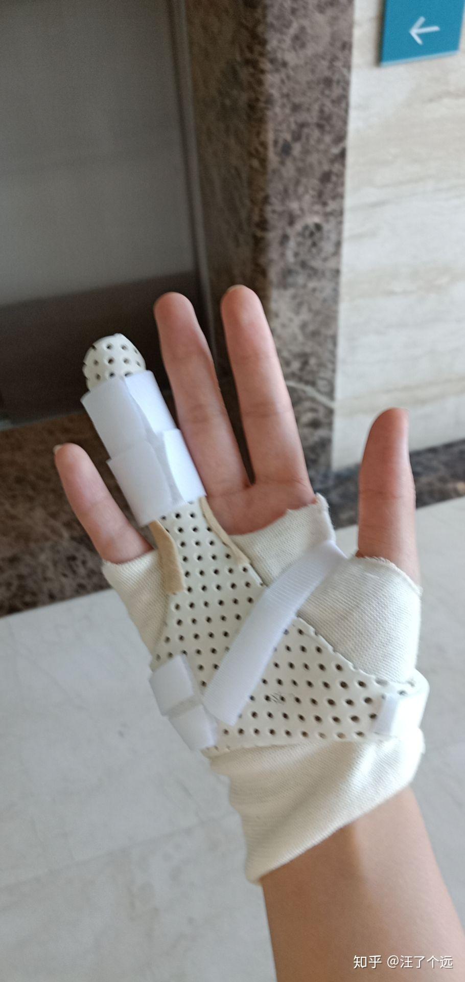 手指头骨折是种怎样的体验? - 知乎
