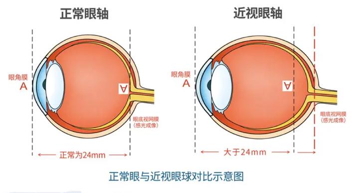 角膜曲率和近视的关系图片