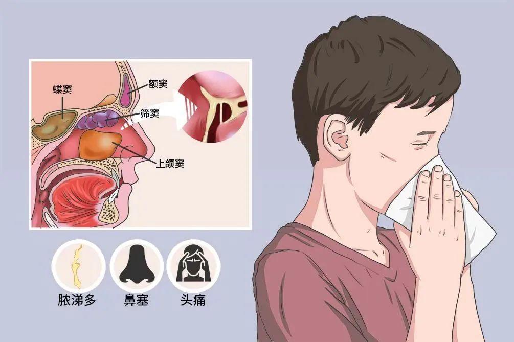 鼻窦炎头痛难忍？揭秘四种类型的鼻窦炎位置和特点 - 知乎