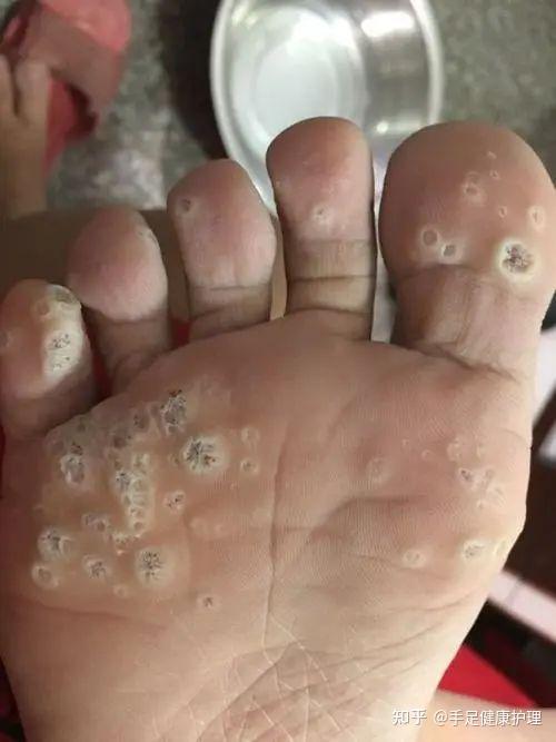 脚垫?胼胝?鸡眼?跖疣?刺猴?傻傻分不清? - 知乎