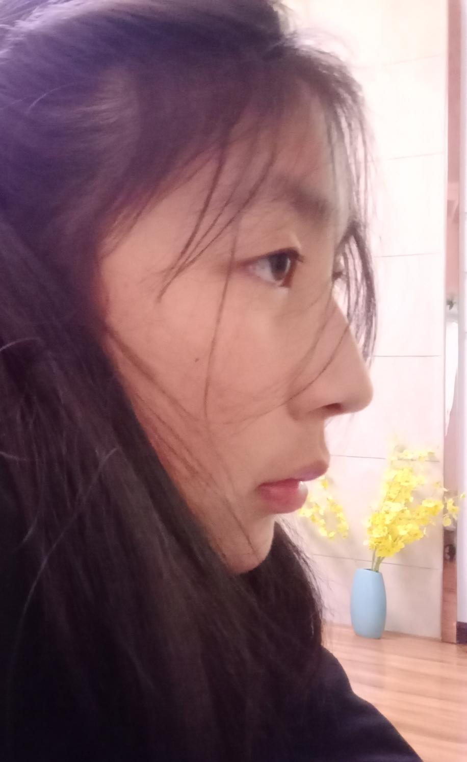 侧面看眼睛非常突眉骨低和鼻子连接不起来是怎么回事