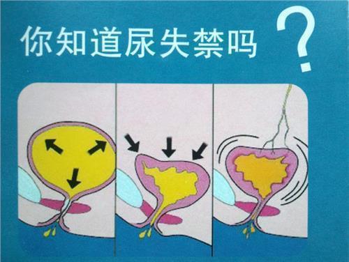 女性尿失禁早期发现与康复，防漏效果更好！ - 知乎