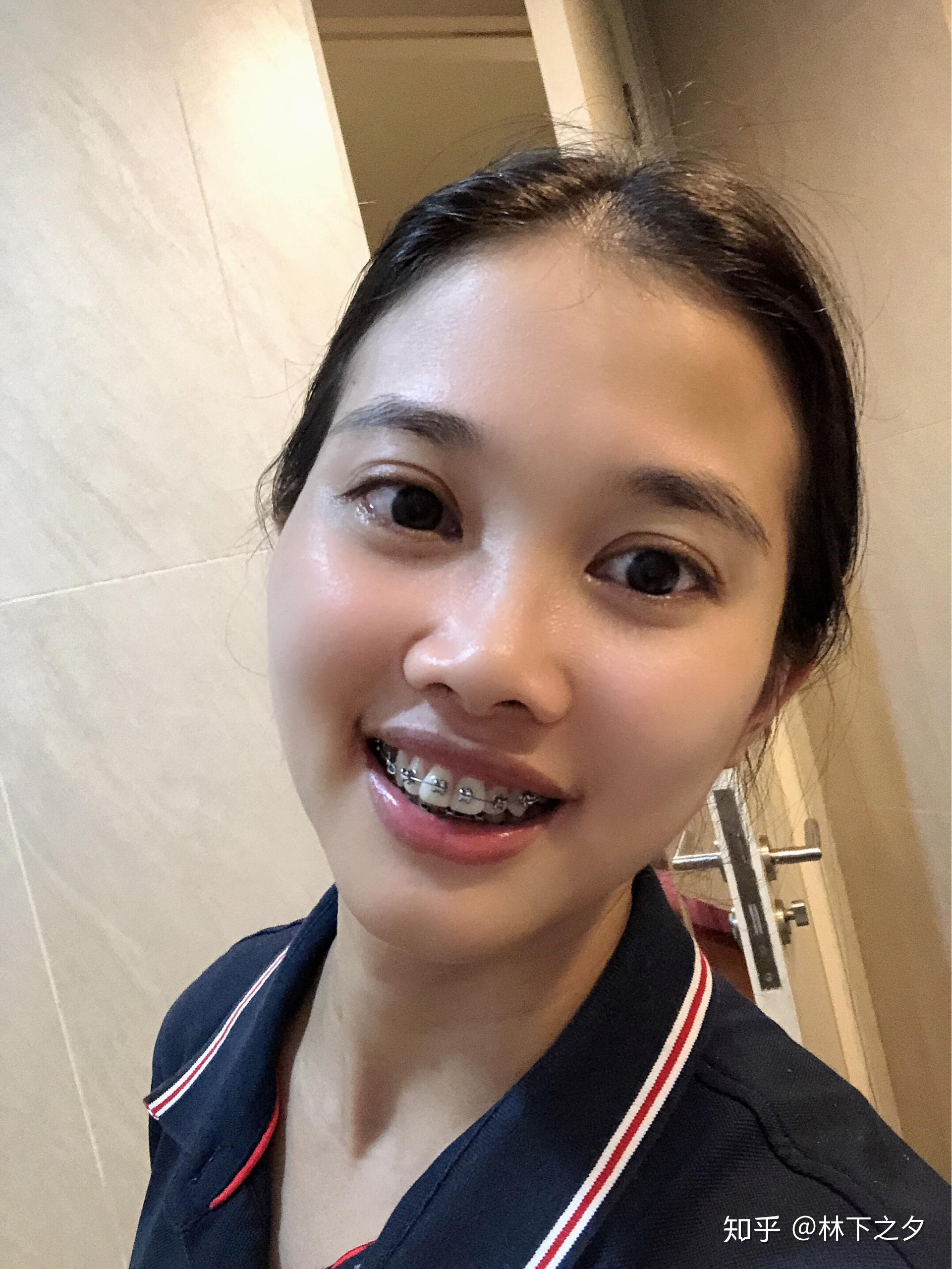 刚带上牙套会不会很丑? - 知乎