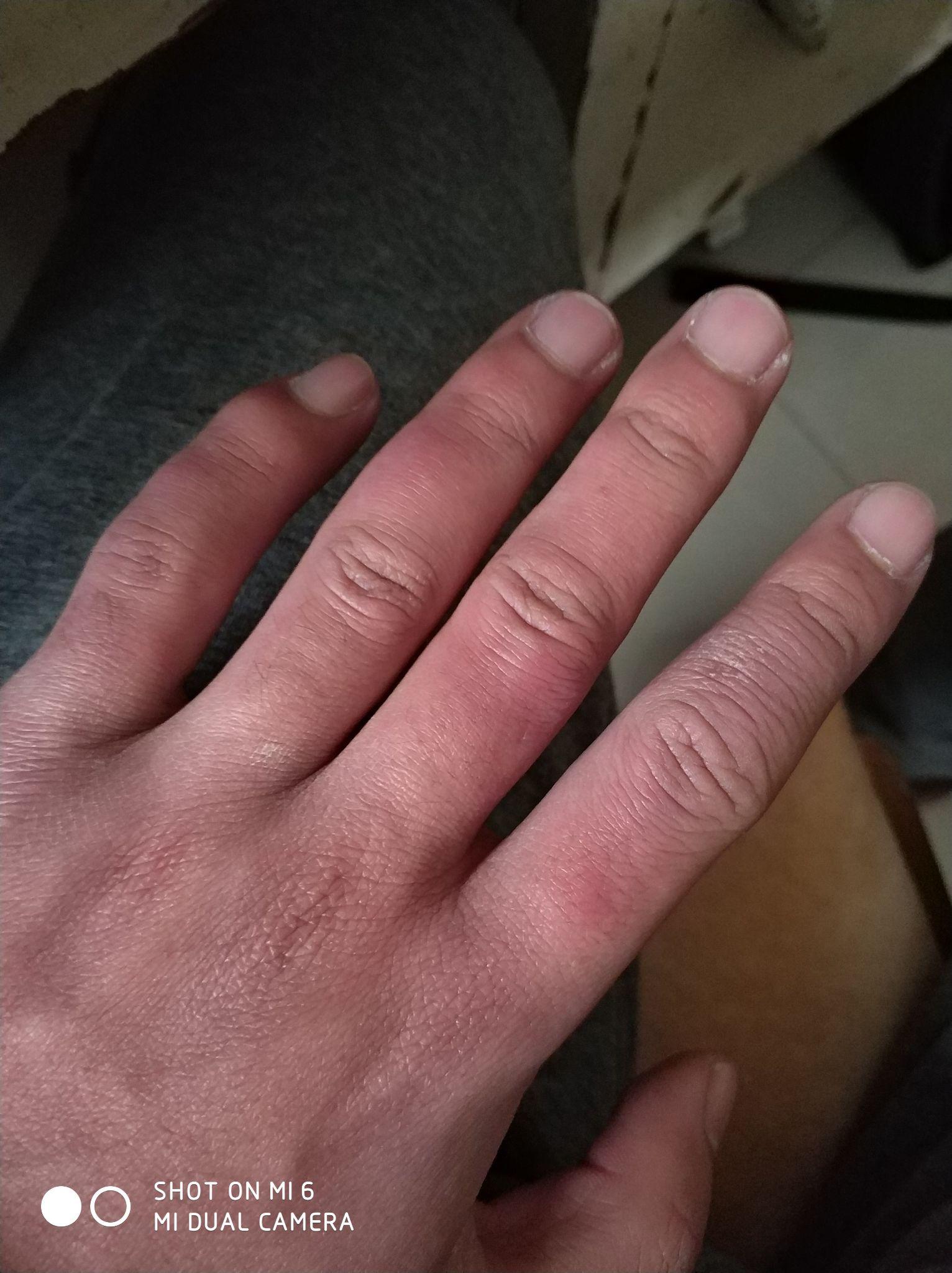 一双10多年的冻疮手好难看