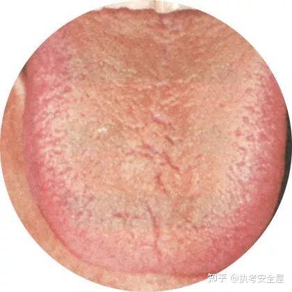 【舌诊大全】120种常见的舌苔超清彩色图谱,建议收藏! - 知乎