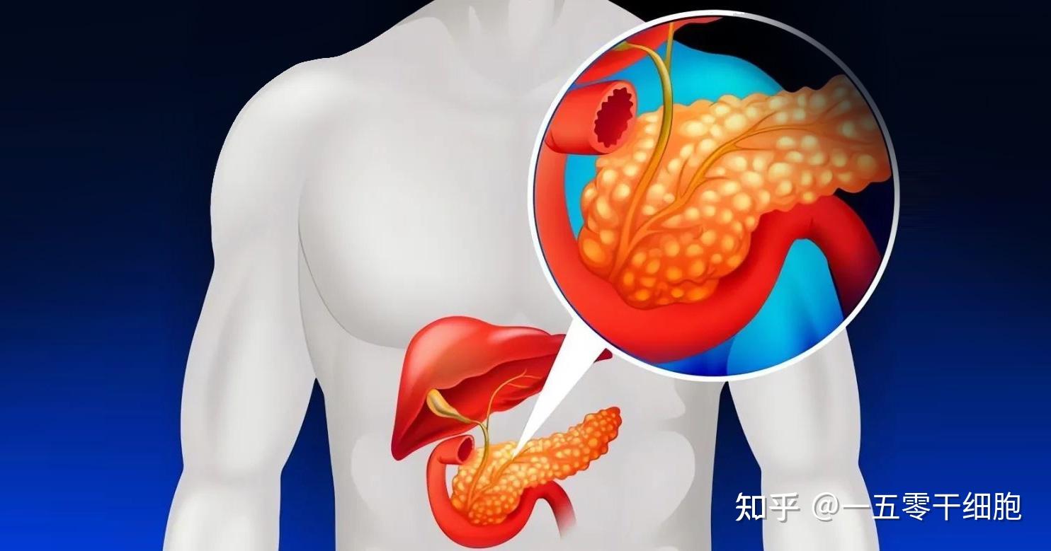 最新研究揭示!MSCs在重症急性胰腺炎中的治疗作用 - 知乎