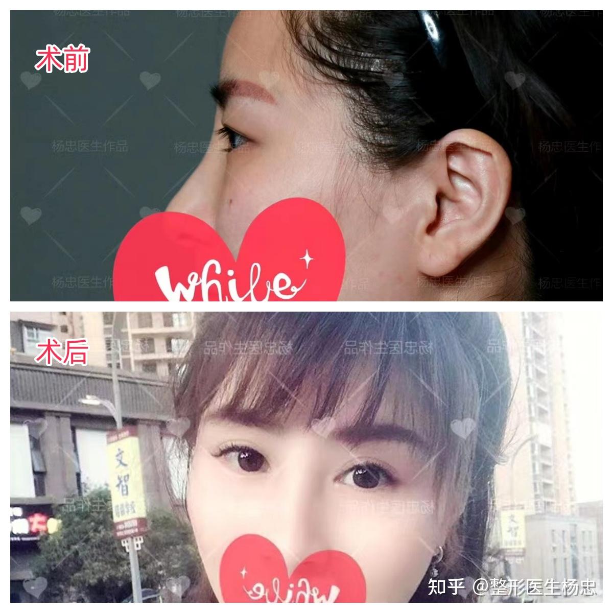 如何才能像赵金麦一样逆袭肿泡眼、凸眼球？ - 知乎