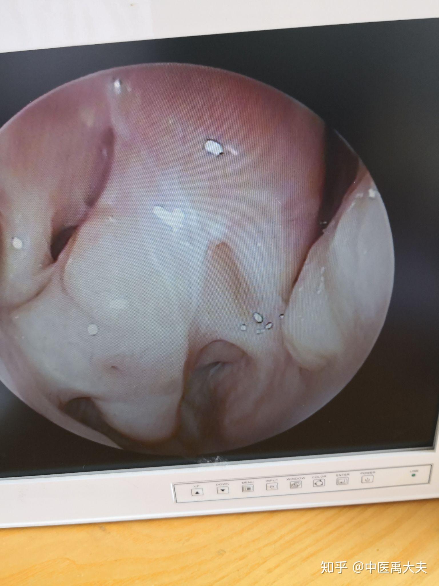 鼻炎严重导致鼻腔堵塞使用口呼吸有没有什么解决办法? - 知乎