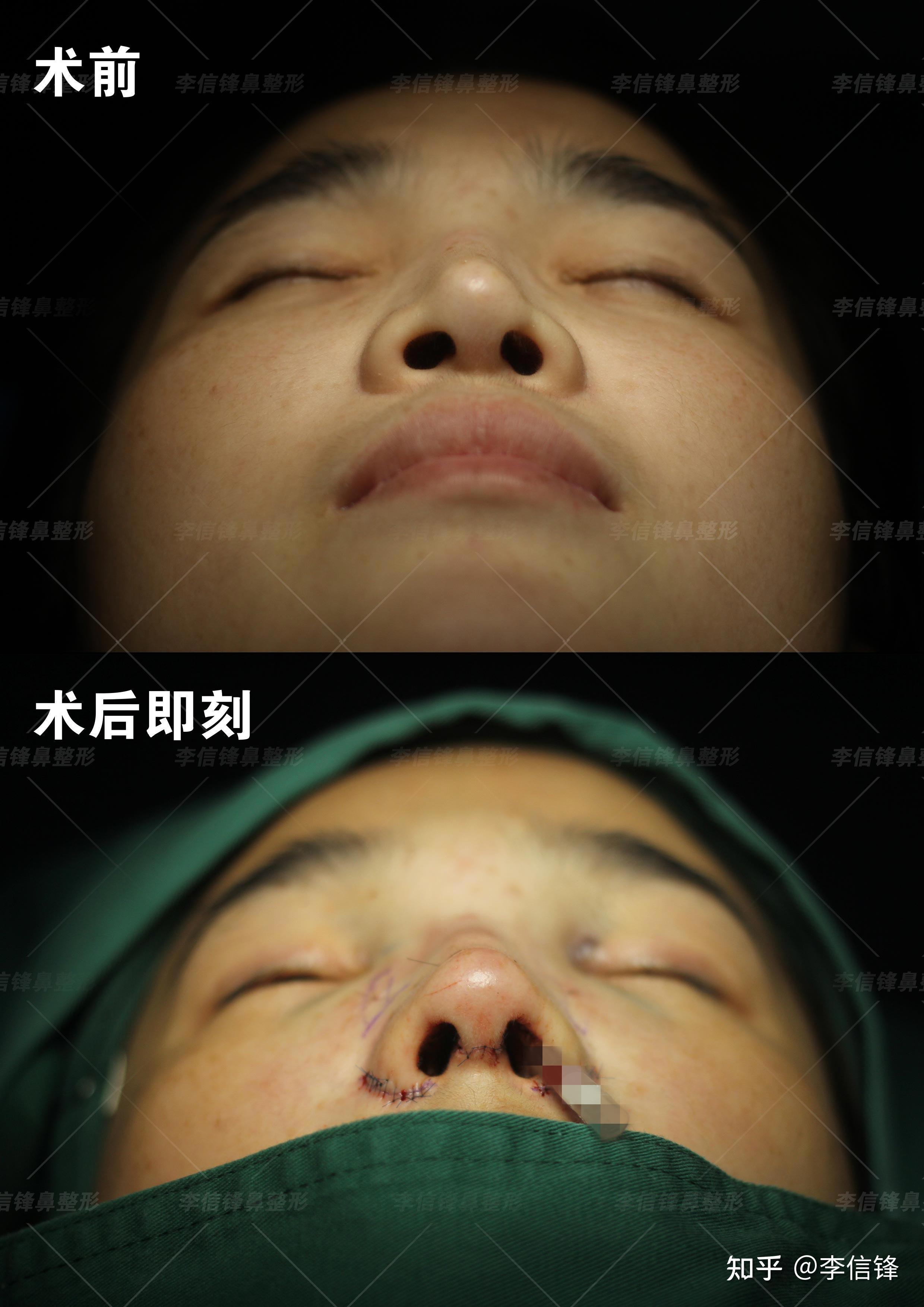 长鼻子缩短,歪鼻矫正修复案例,术后即刻对比
