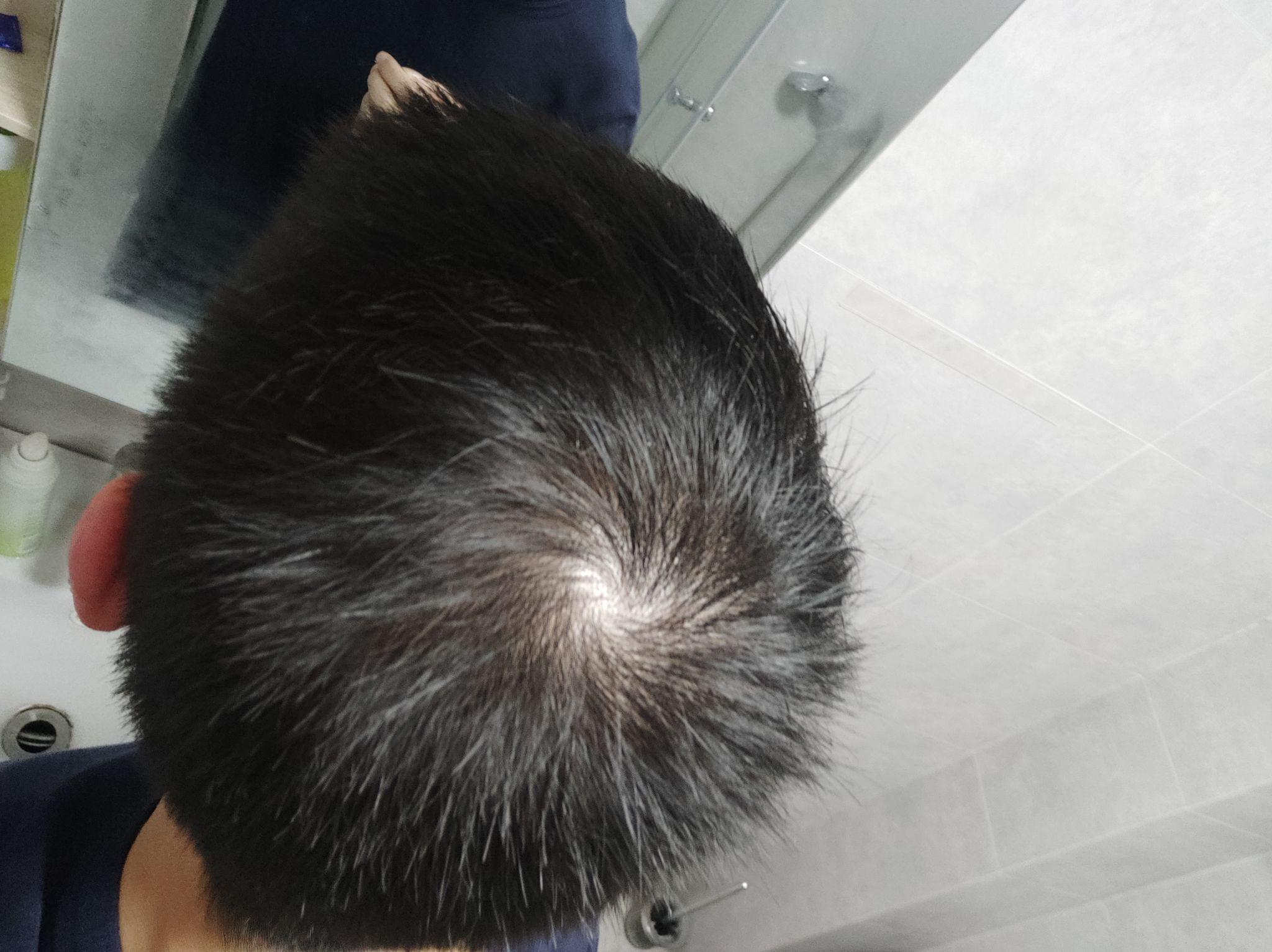 发旋处头发太少了！！！，我是不是要秃了，怎么办啊！？ - 知乎