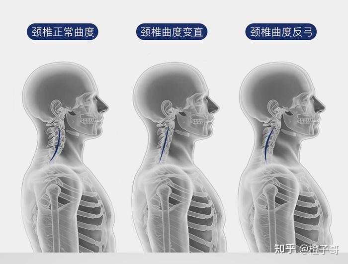 颈椎不舒服到底应该睡什么枕头?