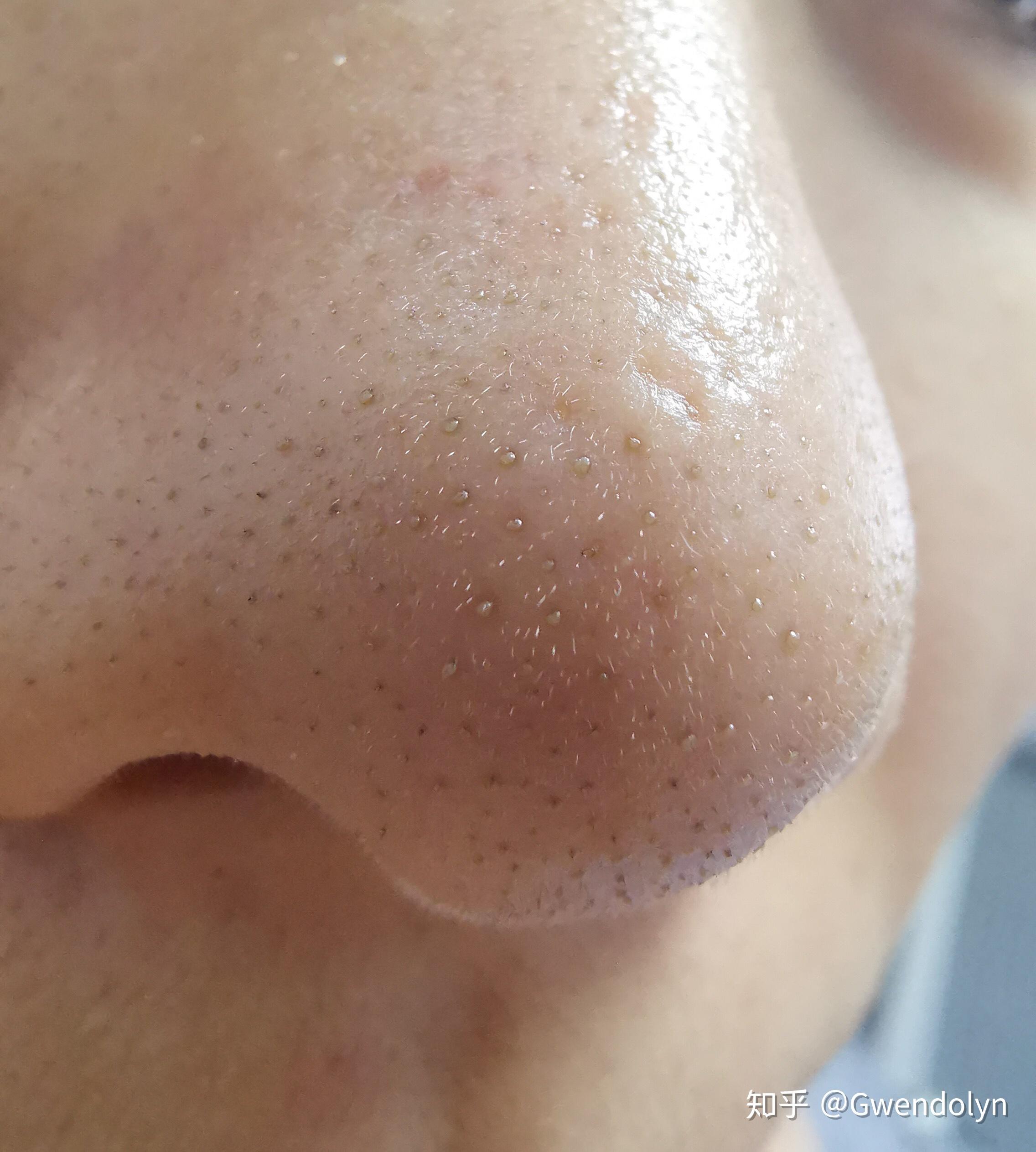 请问这种黑头如何去除