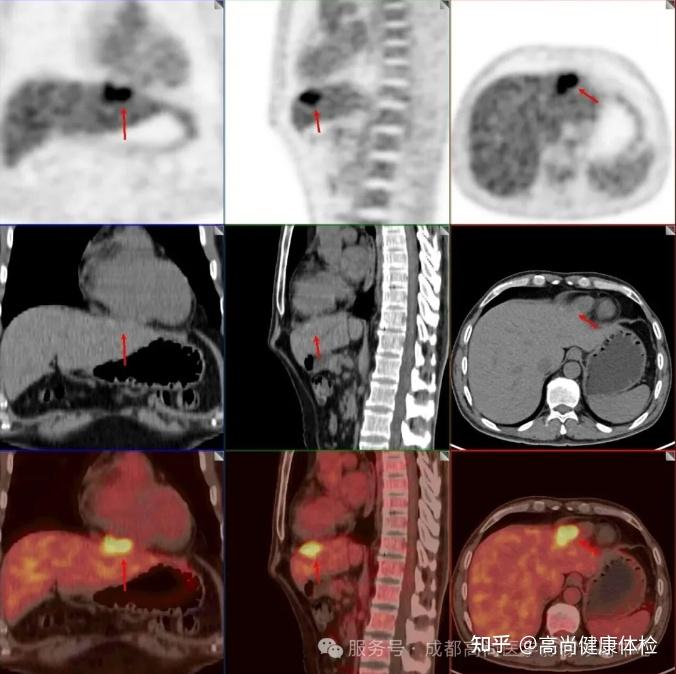 47岁男大便不成形发现直肠腺癌,18F-FDG PET/CT联合HR-MR评估全身情况 - 知乎