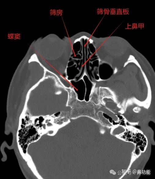 鼻窦 CT 各部位名称解析与鼻腔解剖基础知识 - 知乎