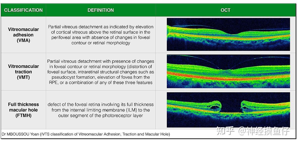 R. October Chen et al. (2019) Retinal OCT Image Analysis 学习笔记 - 知乎