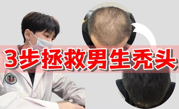 男生秃头怎么救？头发掉的都要秃顶了，有没有适合男生的防脱养发方法？【成分配方师】教你3步拯救秃头秃顶，实测2个月养出浓密秀发！ - 知乎