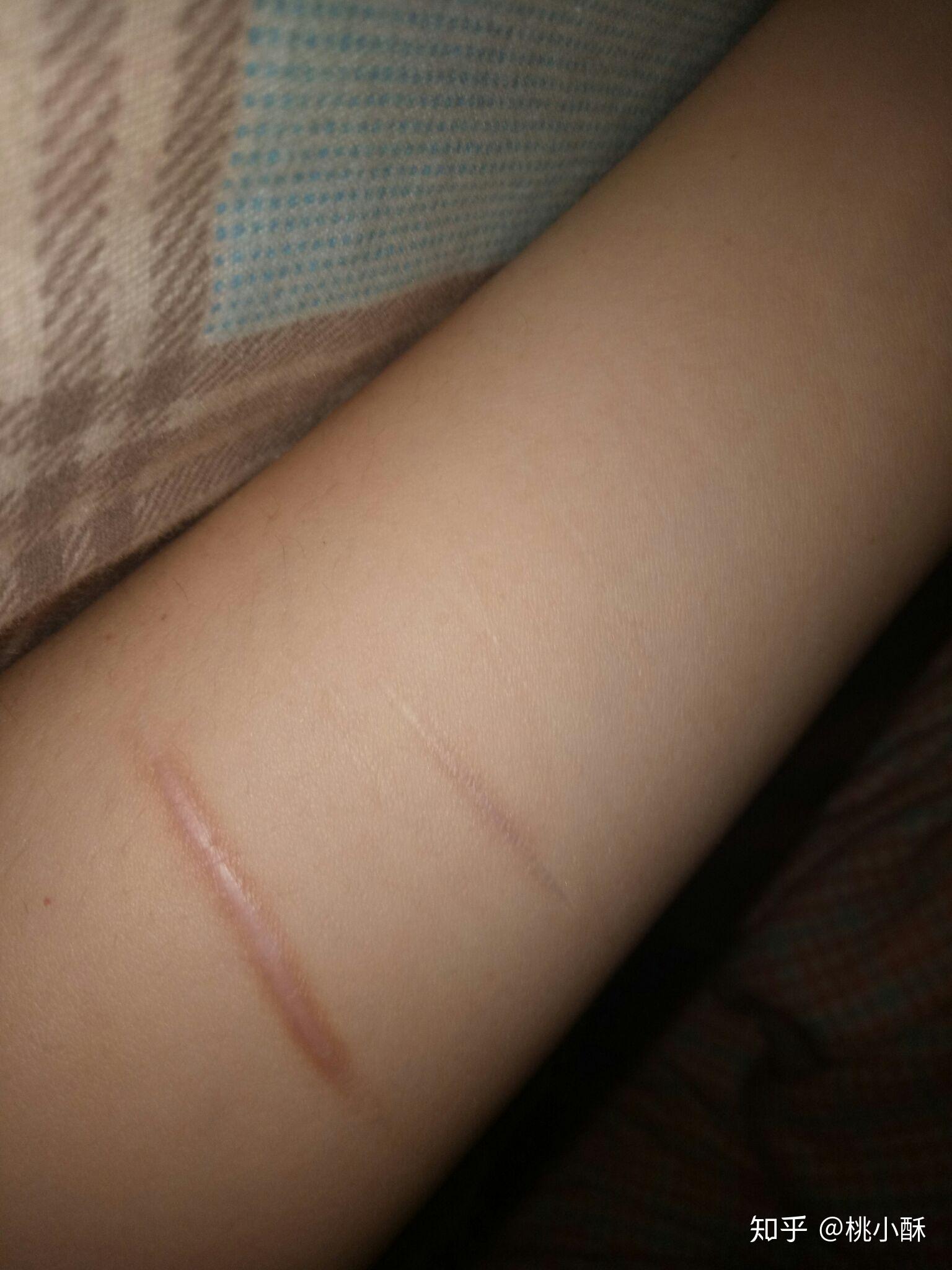 抑郁症患者自残是变态的行为吗? - 知乎