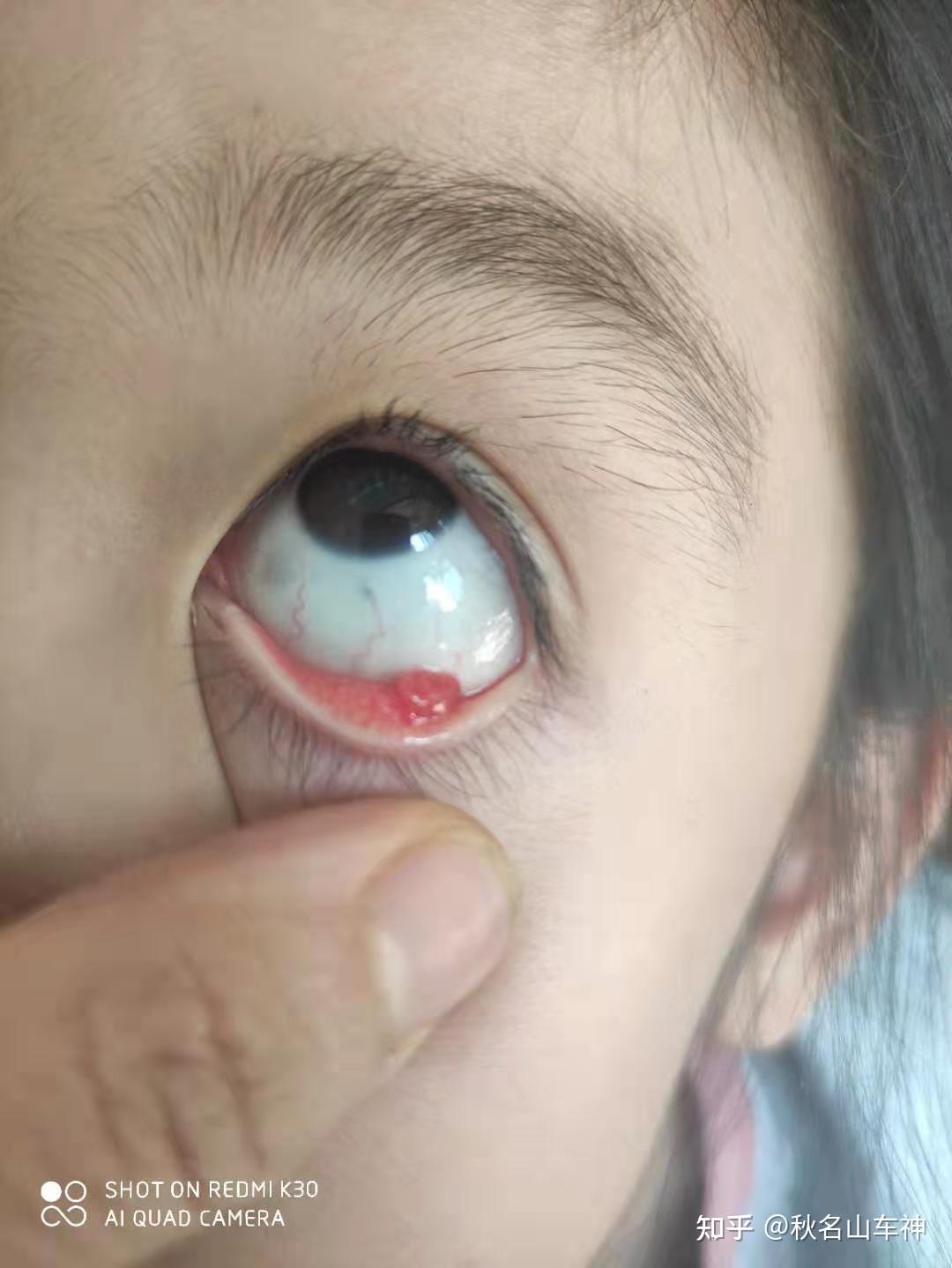 下眼底里面长的肉疙瘩是什么