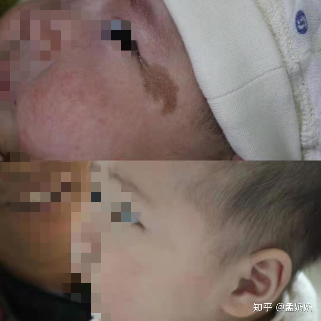 合肥协大皮肤病医院：宝宝脸上有咖啡斑怎么办？ - 哔哩哔哩