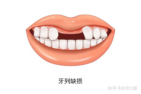 牙列缺损是什么?如何修复牙列缺损? - 知乎