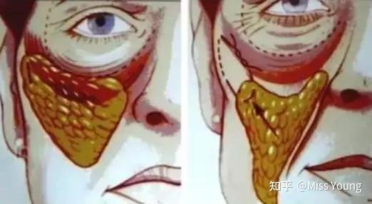 面部发腮怎么解决? - 知乎