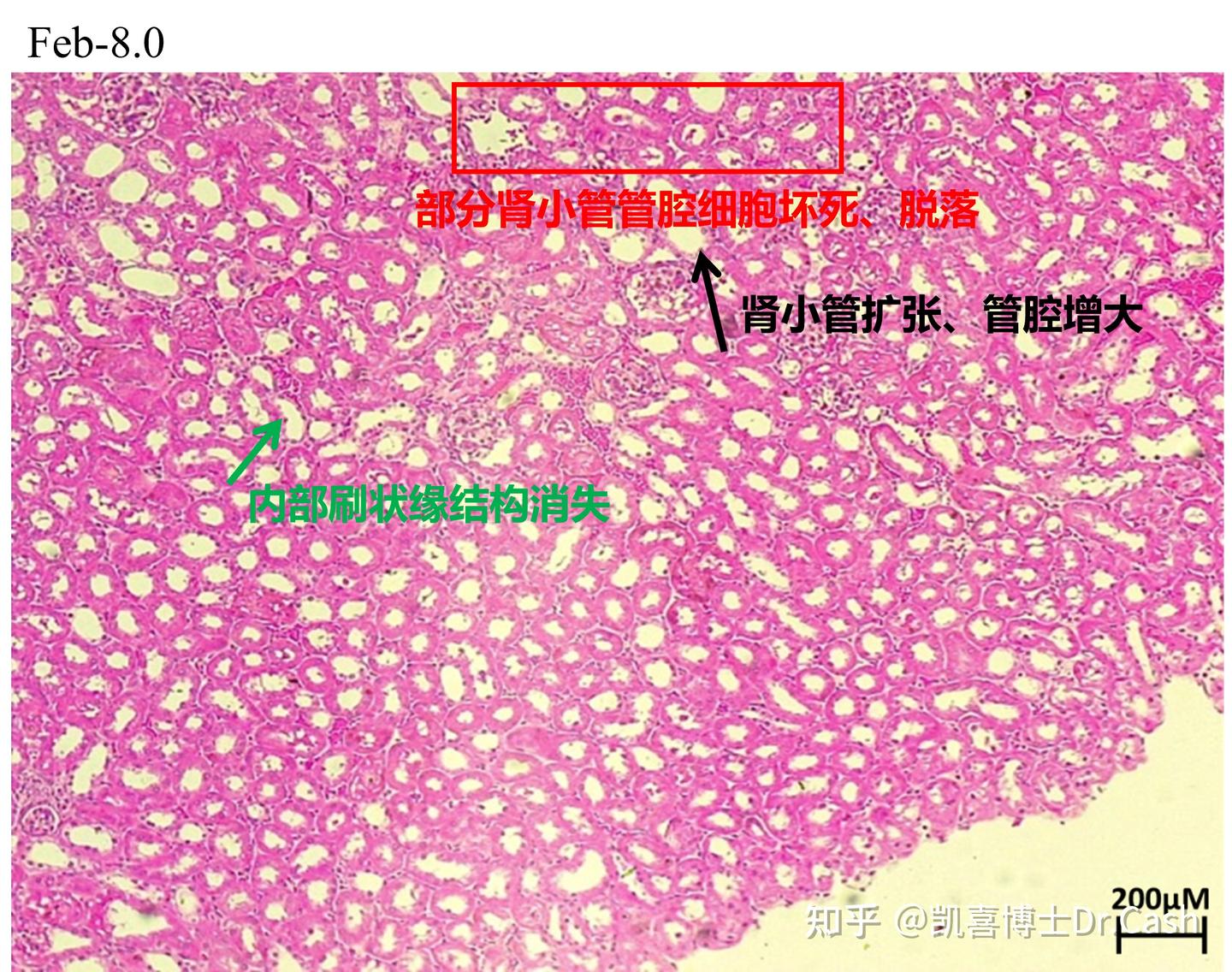 吃非布司他，验血查不出的肾损伤，解剖、切片才能看到的秘密隐患 - 知乎