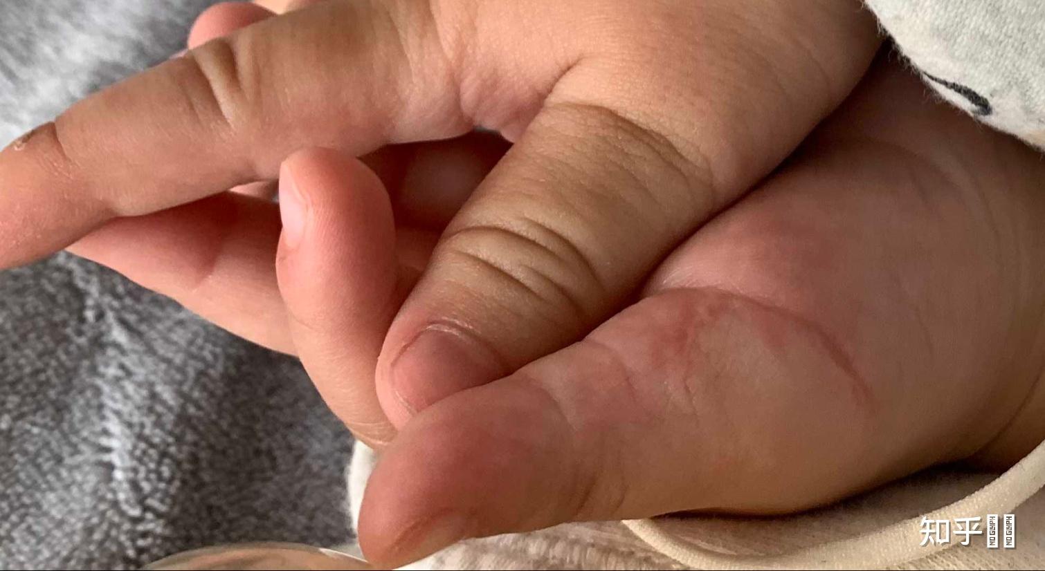 新生儿六指,多大月龄做手术合适?术后可以恢复到完全没有异常吗?