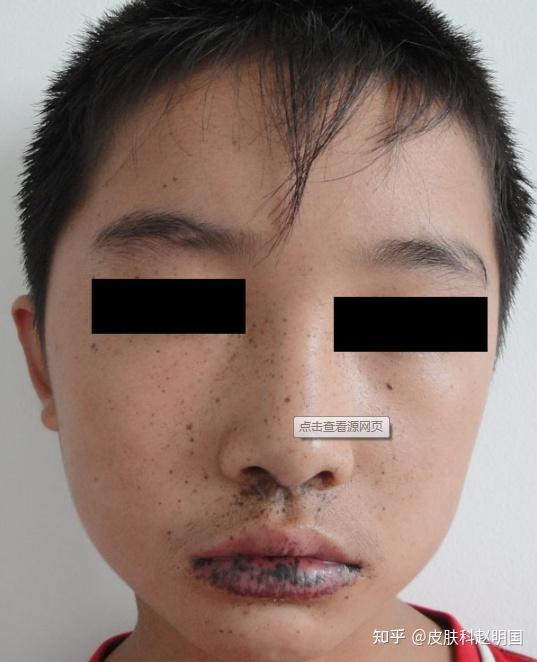 如何判断嘴周黑是从里显现的黑还是色素沉淀应该怎样去除