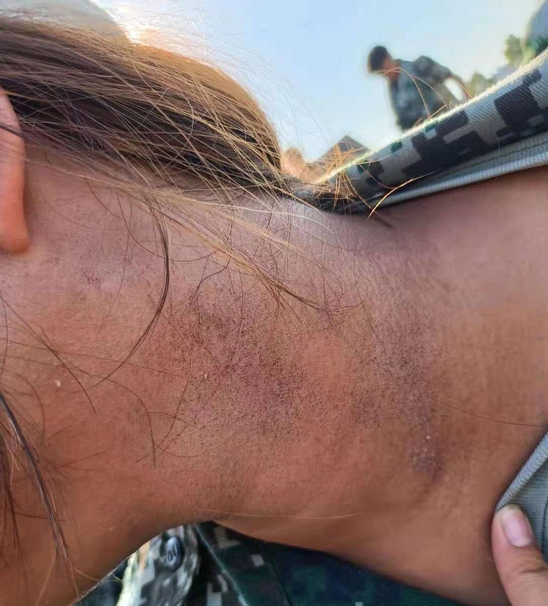 我军训后晒黑了怎么白回来? - 知乎