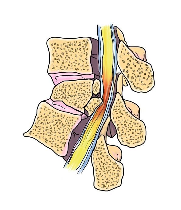 如何降低脊柱脊髓损伤的伤害
