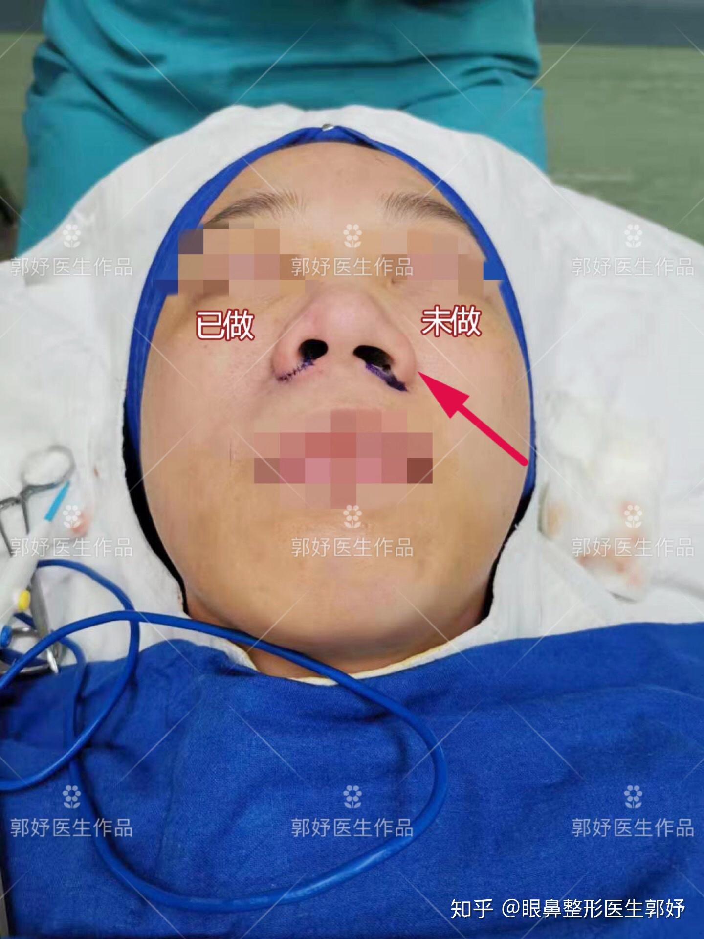 鼻翼缩小该做内切还是外切?会留疤吗?恢复期是多久? - 知乎