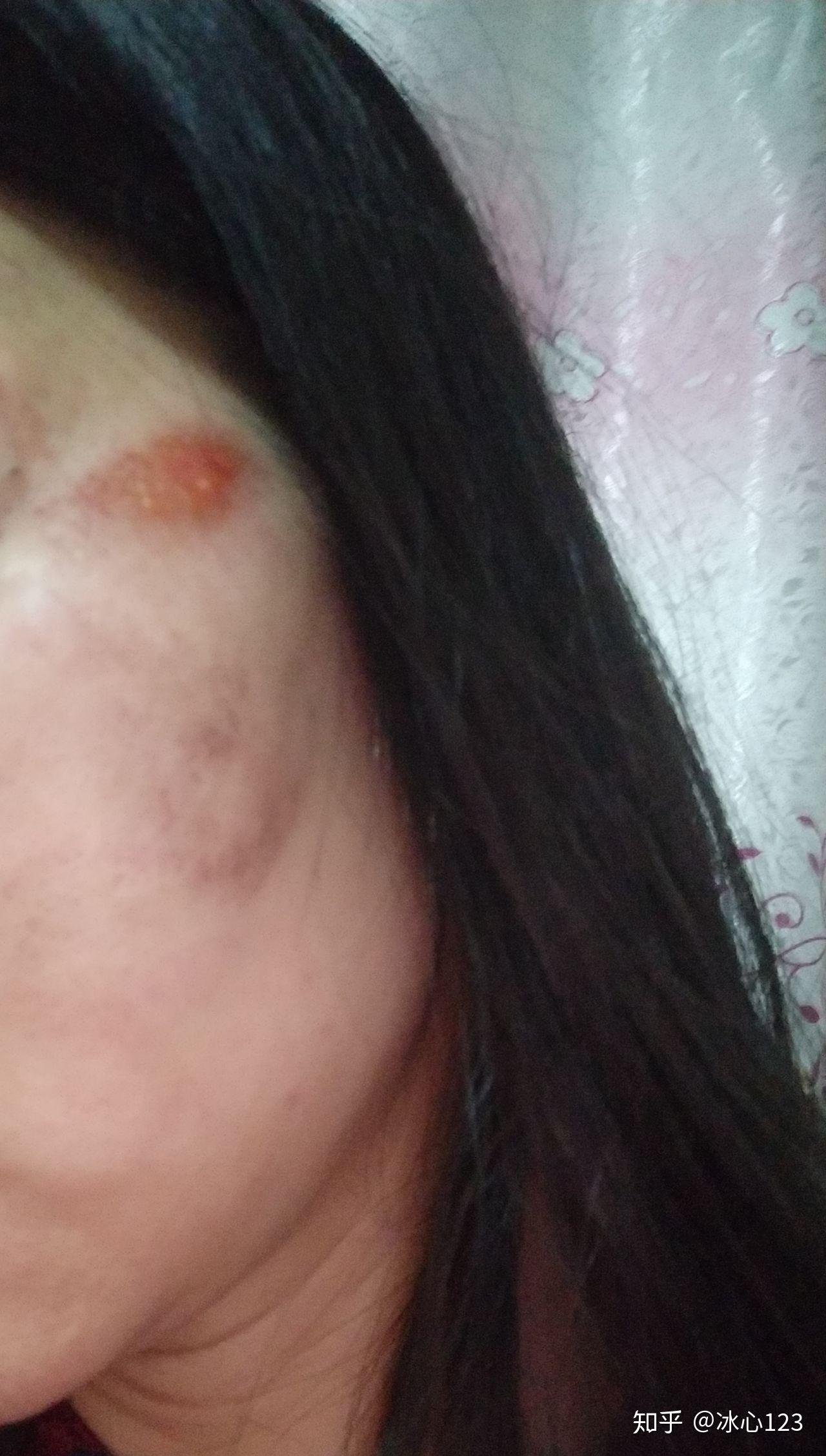 脸部擦伤如图,请问如何恢复? - 知乎