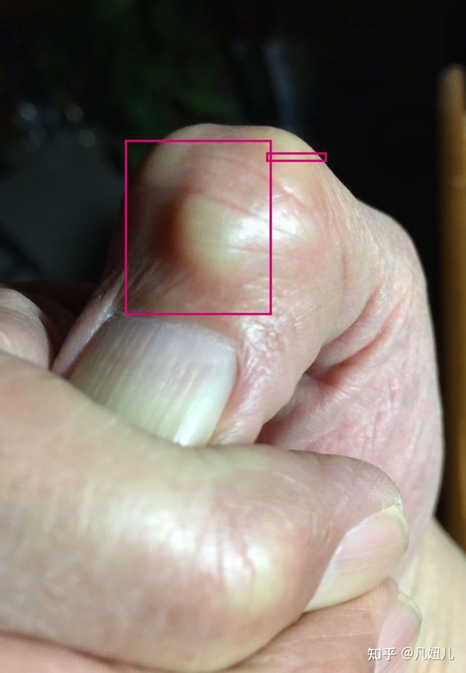 手上这样的凸起是什么