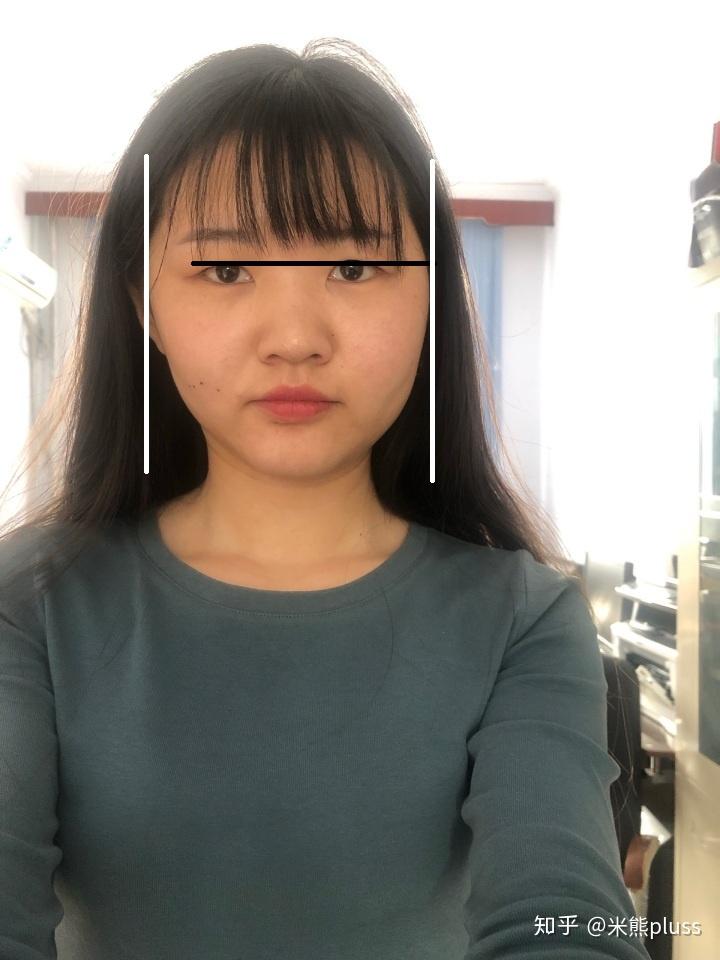 长期单面咀嚼造成大小脸怎么办,如图?