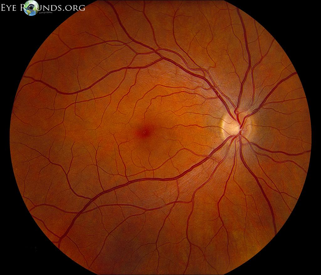 常见全身疾病可以通过眼底检查发现_视网膜