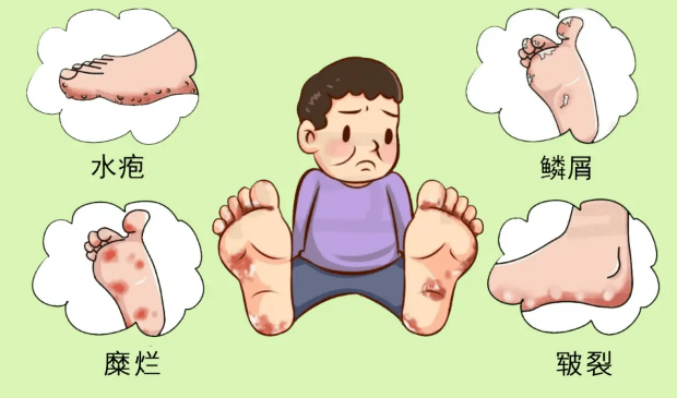 【珠海广肤】脚臭、脚痒、脚脱皮?你想了解的“足癣”干货都在这里! - 知乎