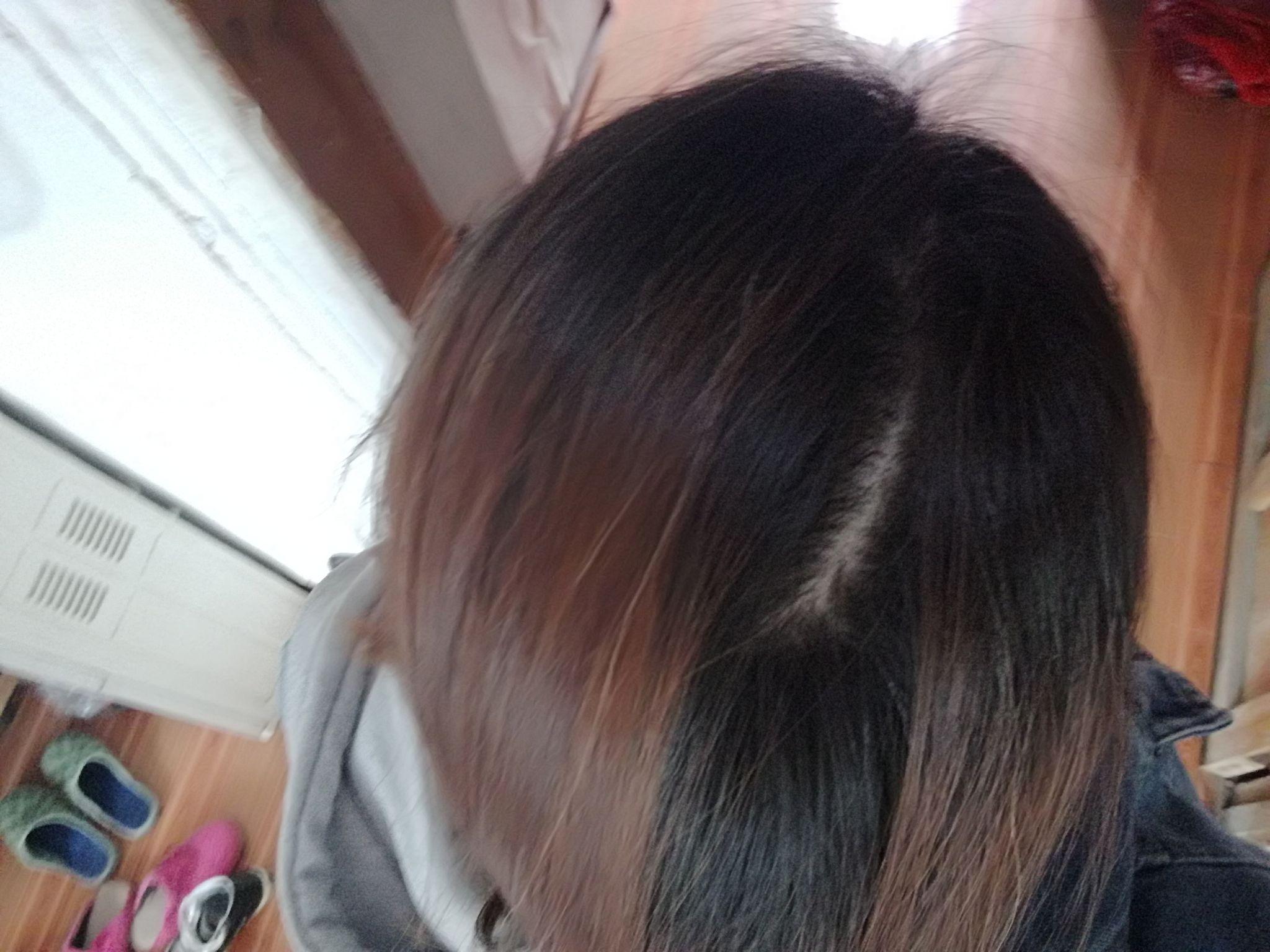 头顶后面有一条线没头发