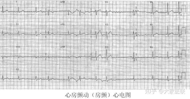 “房颤”与“室颤”,傻傻分不清楚? - 知乎