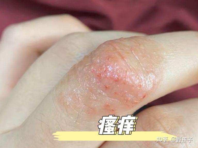 为什么每到冬天手就会出现冻疮?试试这个方法,管用!拿走不谢 - 知乎